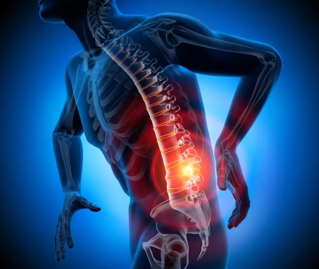 Percutaneous Disc Removal as Out Patient Surgery